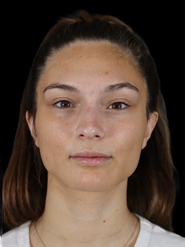 Liquid Rhinoplasty Before & After