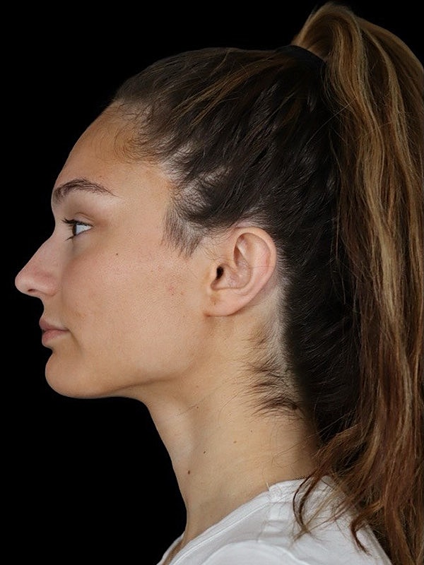 Liquid Rhinoplasty Before & After