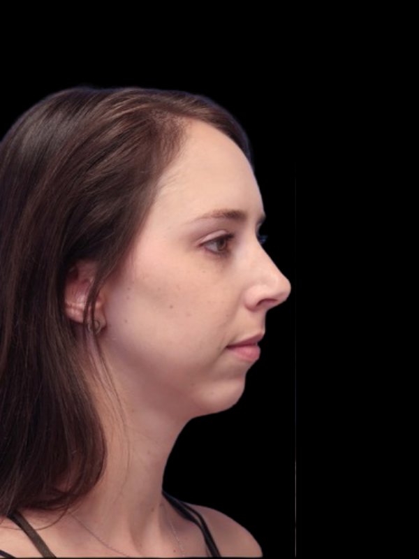 Chin Augmentation Before & After