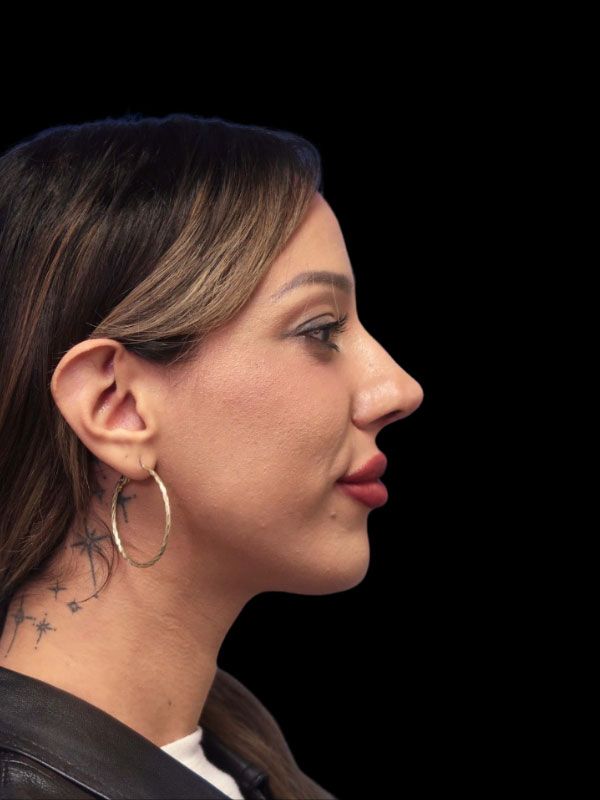 Chin Augmentation Before & After