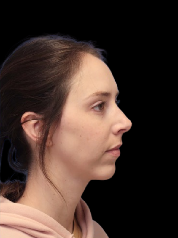 Chin Augmentation Before & After