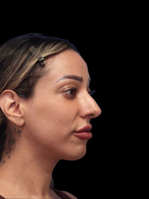 Chin Augmentation Before & After