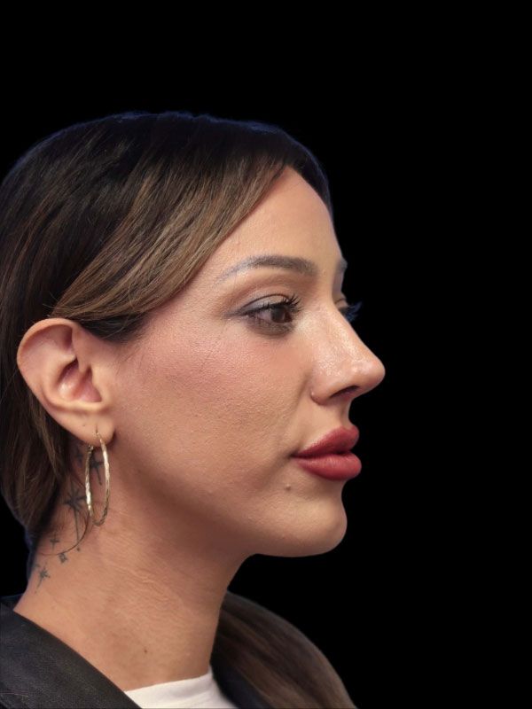 Chin Augmentation Before & After