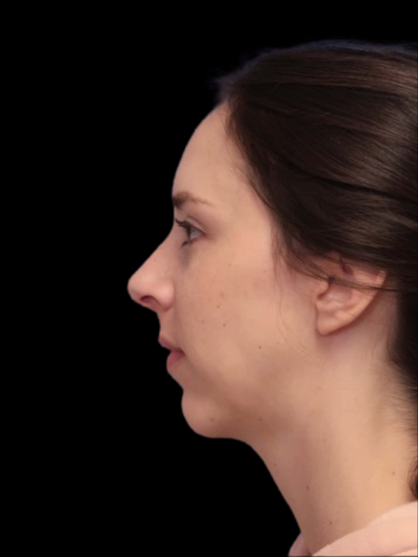 Chin Augmentation Before & After