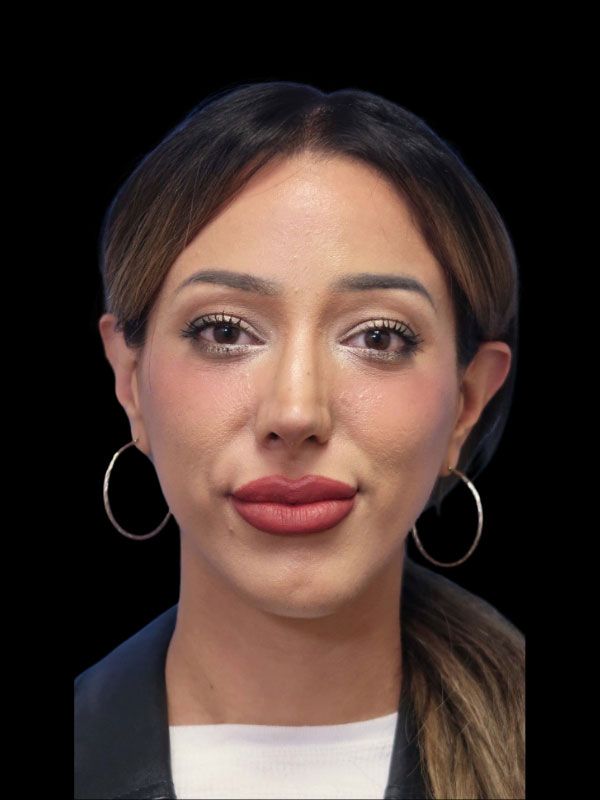 Chin Augmentation Before & After