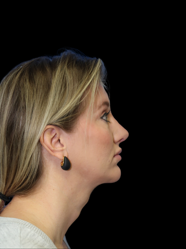 Chin Augmentation Before & After