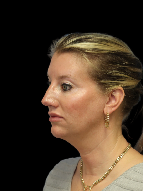 Chin Augmentation Before & After