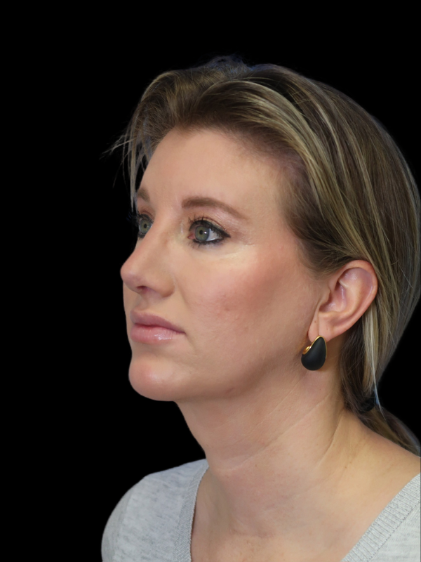 Chin Augmentation Before & After