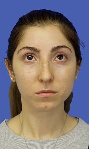 Chin Augmentation Before & After