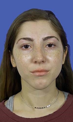 Chin Augmentation Before & After