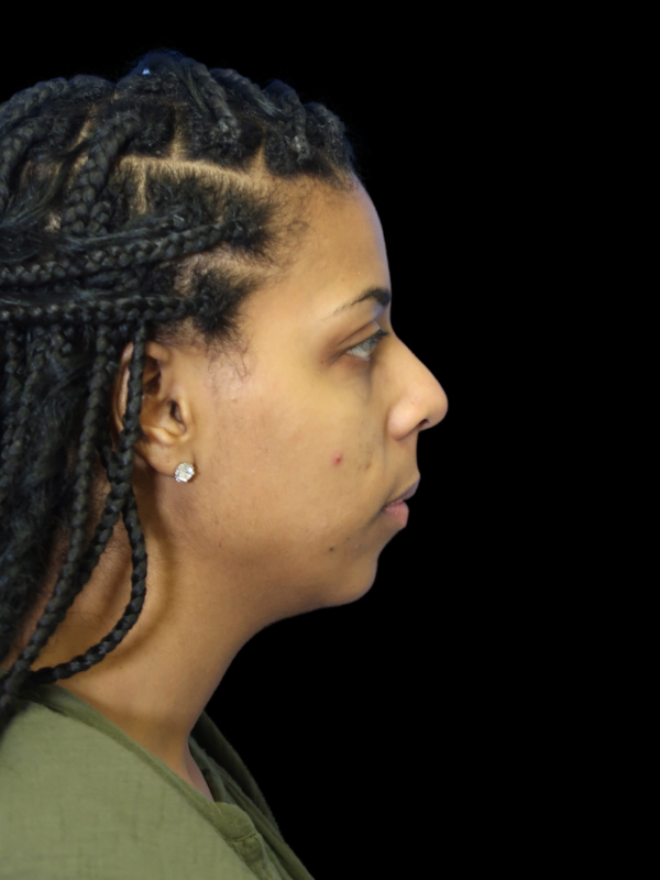 Chin Augmentation Before & After