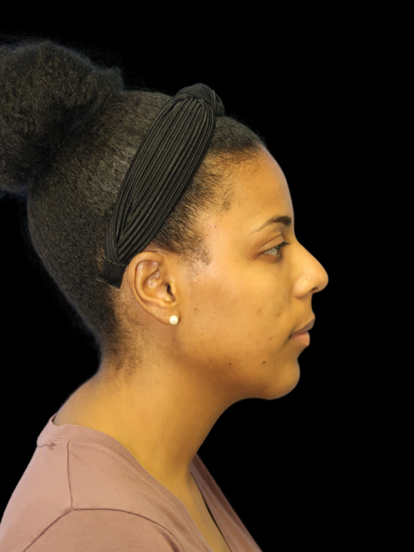 Chin Augmentation Before & After