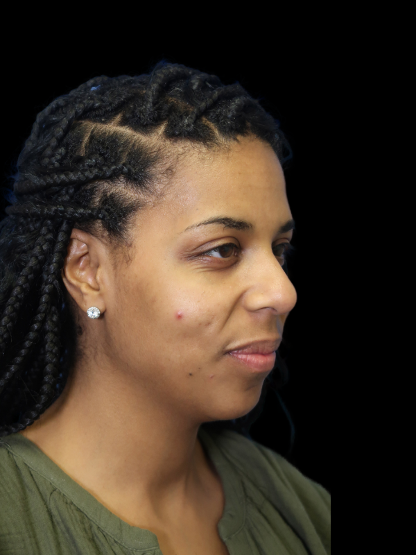 Chin Augmentation Before & After