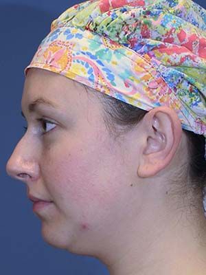 Neck Liposuction Before & After