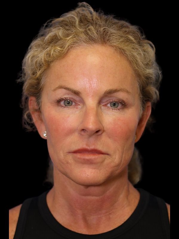 Deep Plane Facelift Gallery Before & After