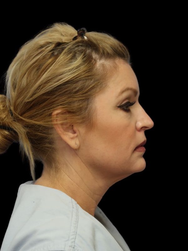 Deep Plane Facelift Gallery Before & After