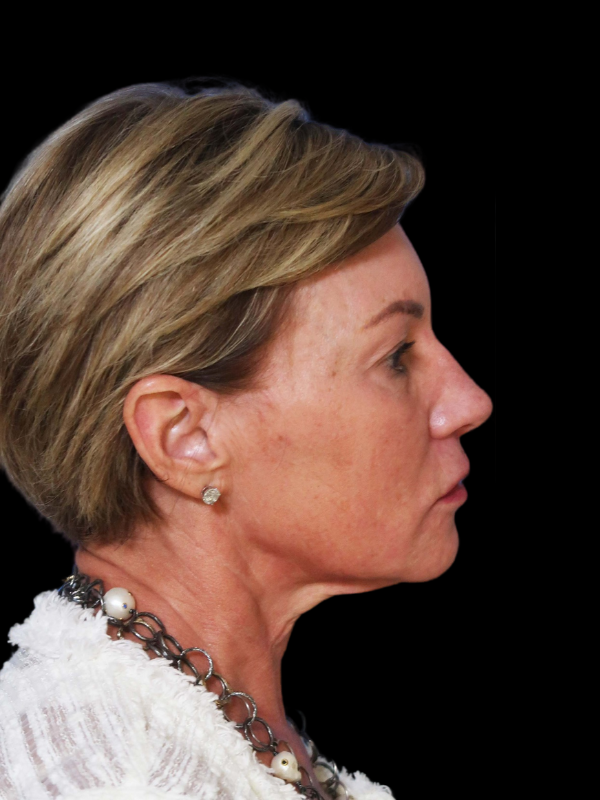 Deep Plane Facelift Gallery Before & After