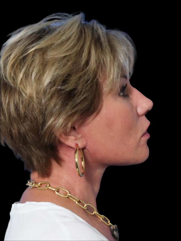 Deep Plane Facelift Gallery Before & After