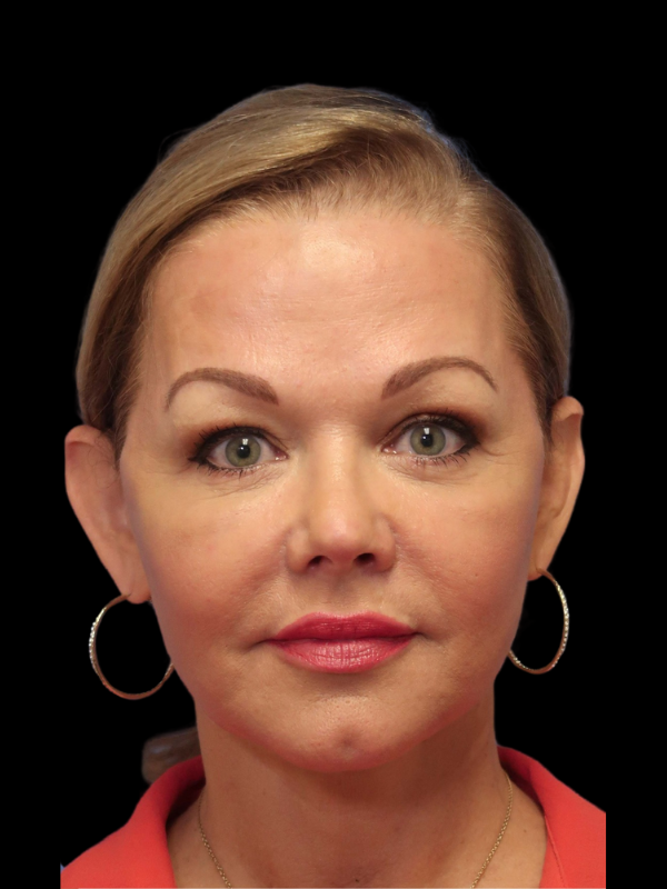 Deep Plane Facelift Gallery Before & After