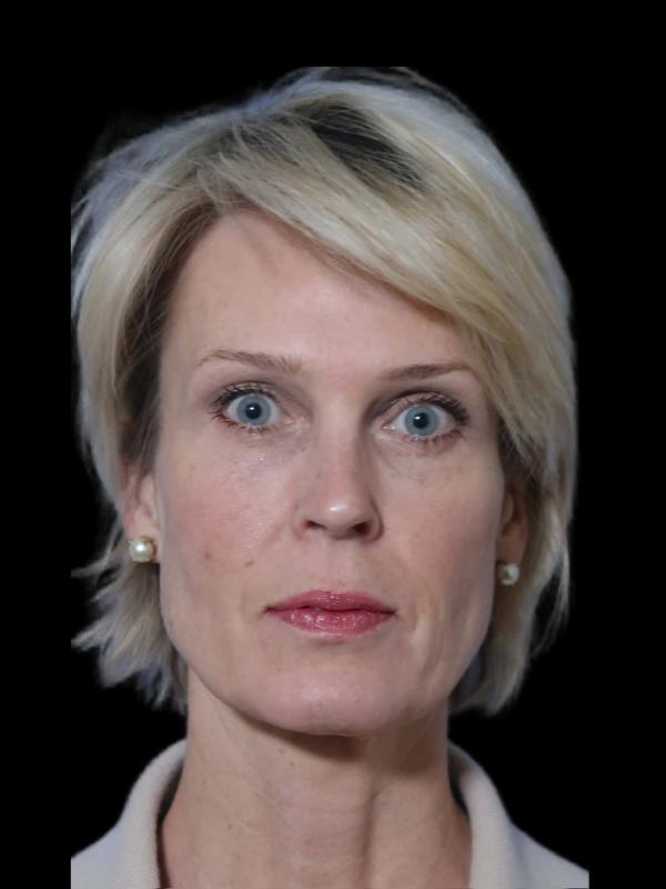 Deep Plane Facelift Gallery Before & After