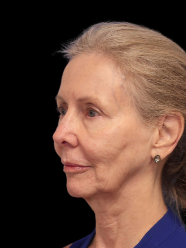 Deep Plane Facelift Gallery Before & After