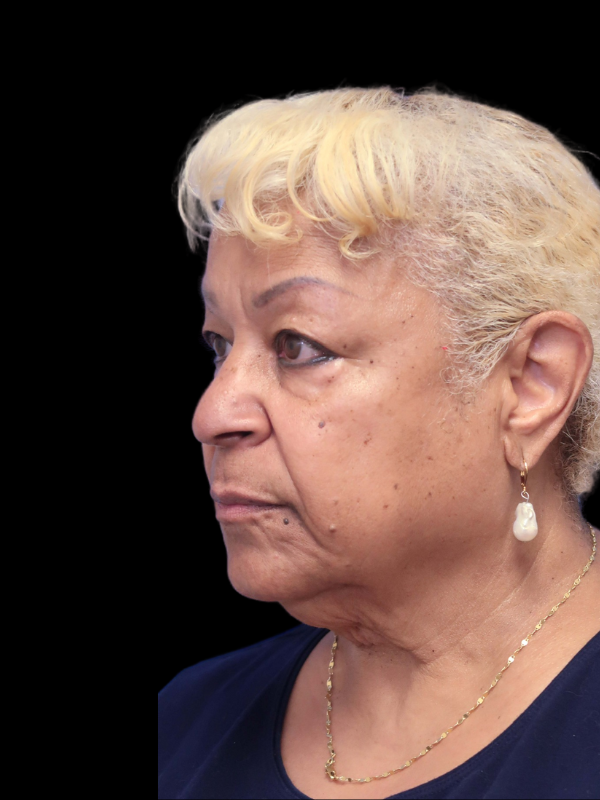 Deep Plane Facelift Gallery Before & After