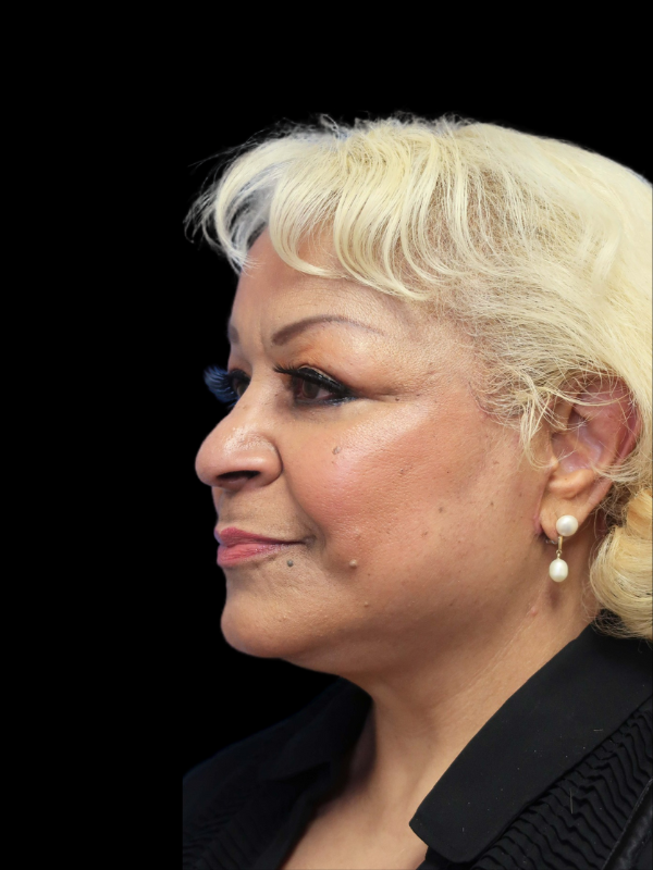 Deep Plane Facelift Gallery Before & After