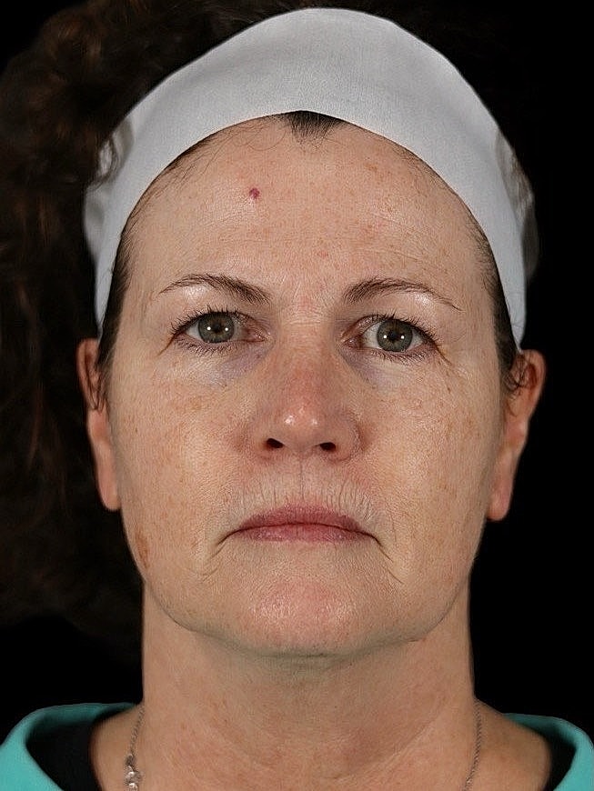 Deep Plane Facelift Gallery Before & After