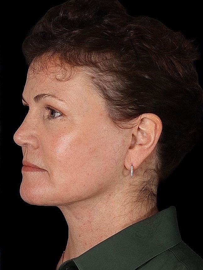 Deep Plane Facelift Gallery Before & After