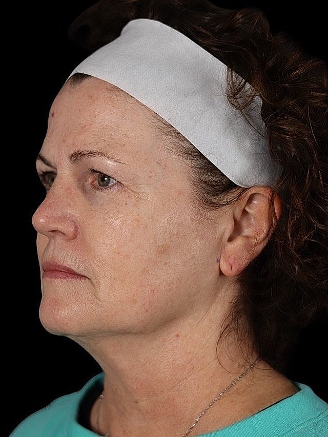 Deep Plane Facelift Gallery Before & After