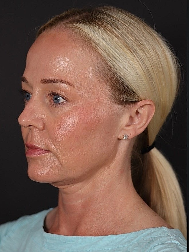 Deep Plane Facelift Gallery Before & After