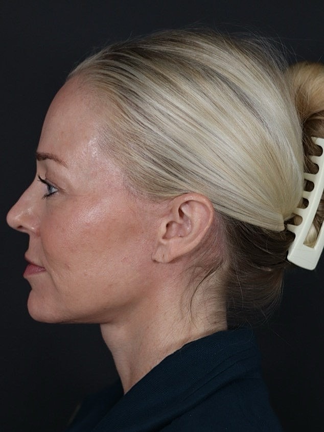 Deep Plane Facelift Gallery Before & After