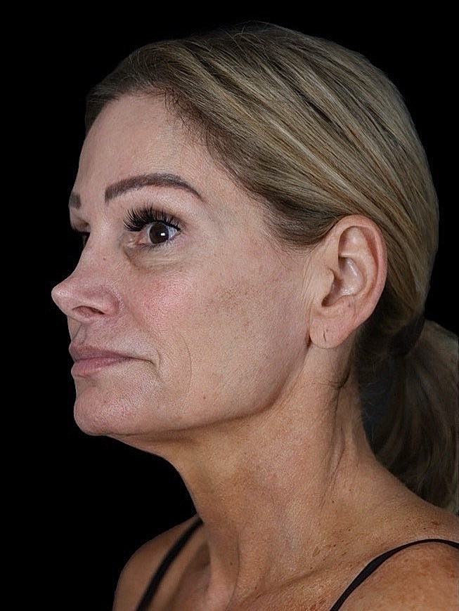 Deep Plane Facelift Gallery Before & After