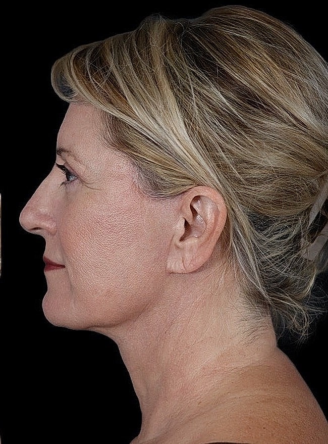 Deep Plane Facelift Gallery Before & After