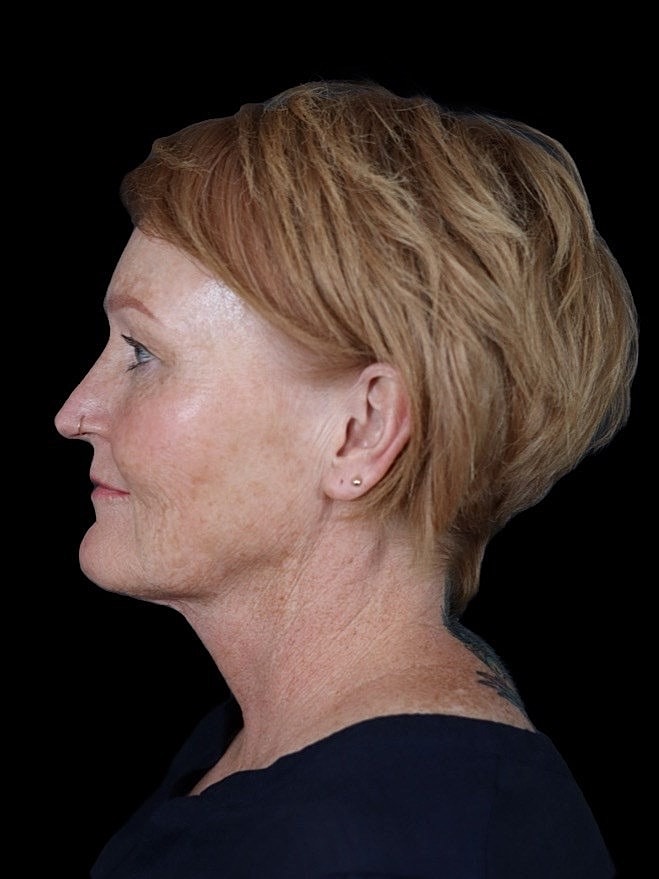 Deep Plane Facelift Gallery Before & After