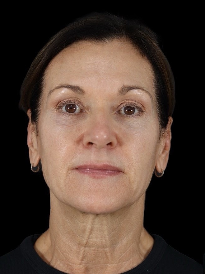 Deep Plane Facelift Gallery Before & After