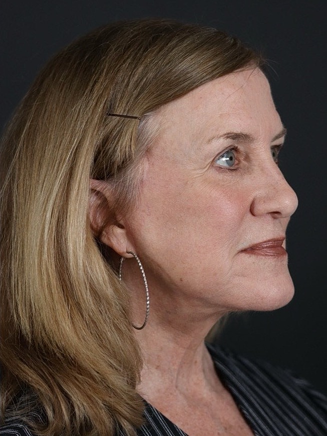 Deep Plane Facelift Gallery Before & After