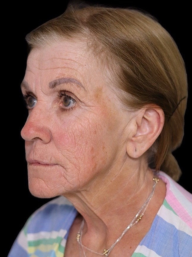 Deep Plane Facelift Gallery Before & After