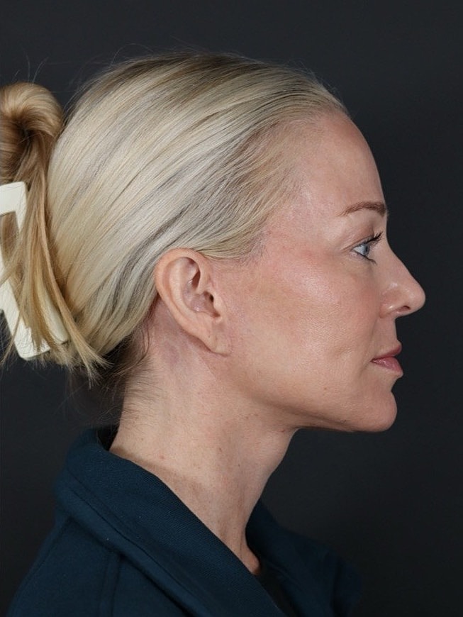 Deep Plane Facelift Gallery Before & After