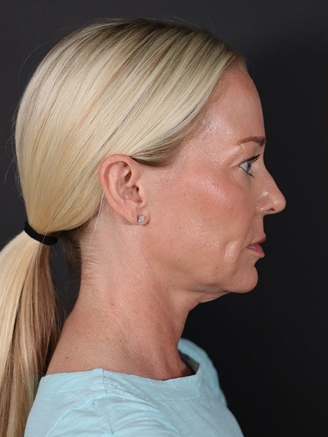 Deep Plane Facelift Gallery Before & After