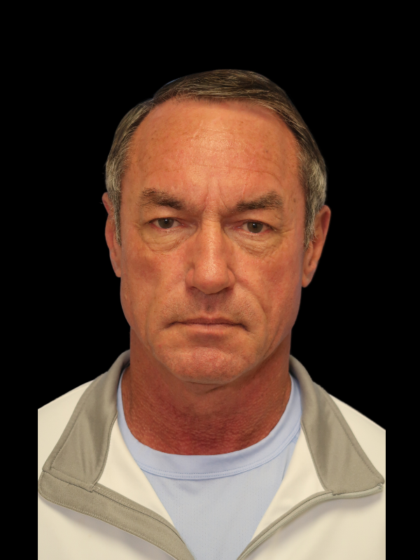 Deep Plane Facelift Gallery Before & After