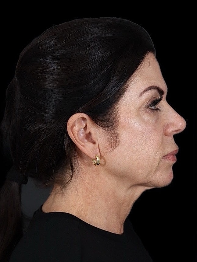 Deep Plane Facelift Gallery Before & After