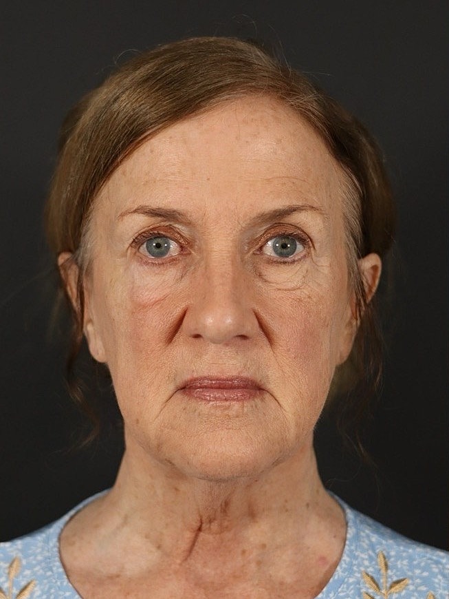 Deep Plane Facelift Gallery Before & After