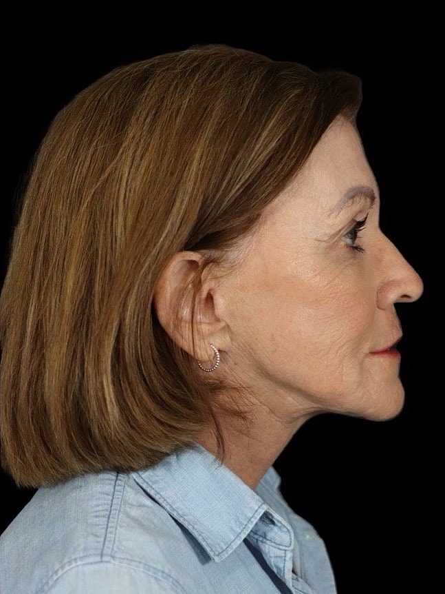 Deep Plane Facelift Gallery Before & After