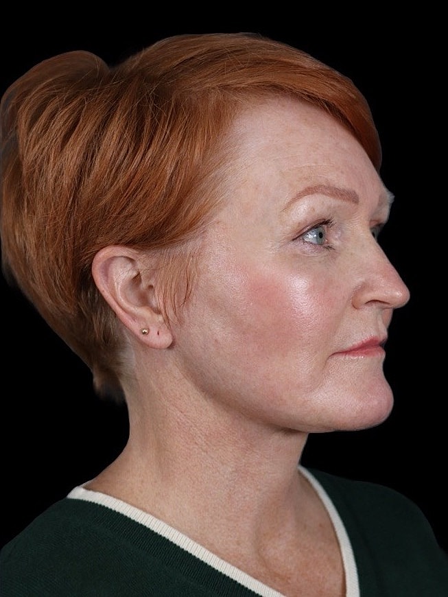 Deep Plane Facelift Gallery Before & After