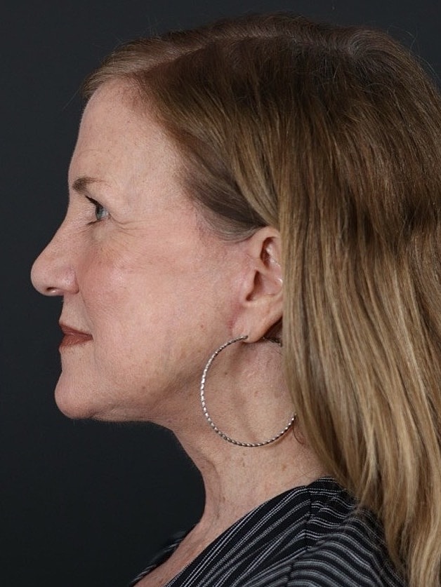 Deep Plane Facelift Gallery Before & After