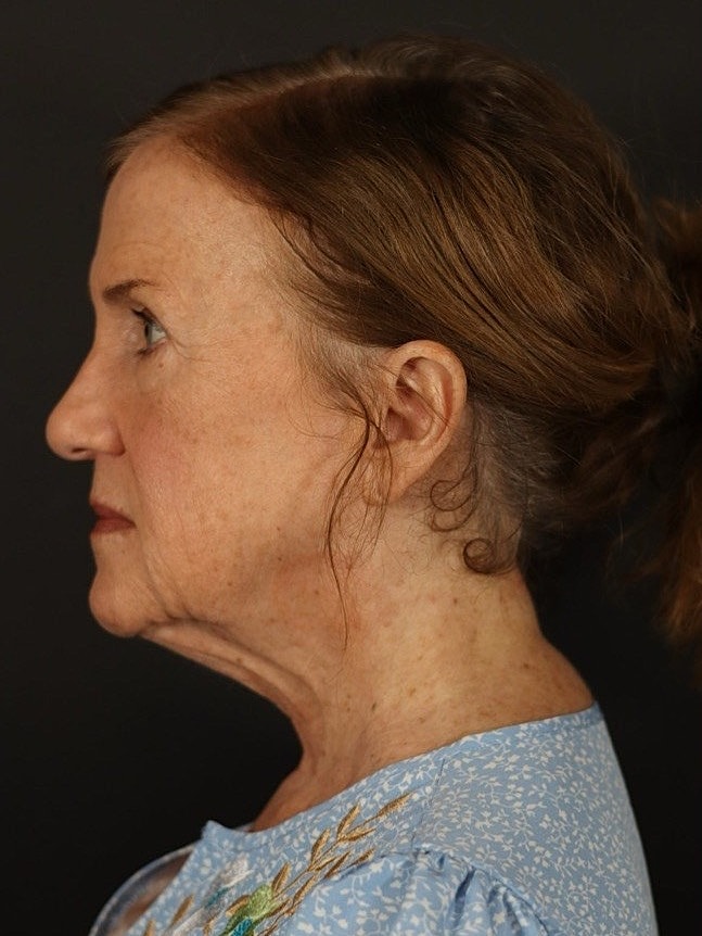 Deep Plane Facelift Gallery Before & After