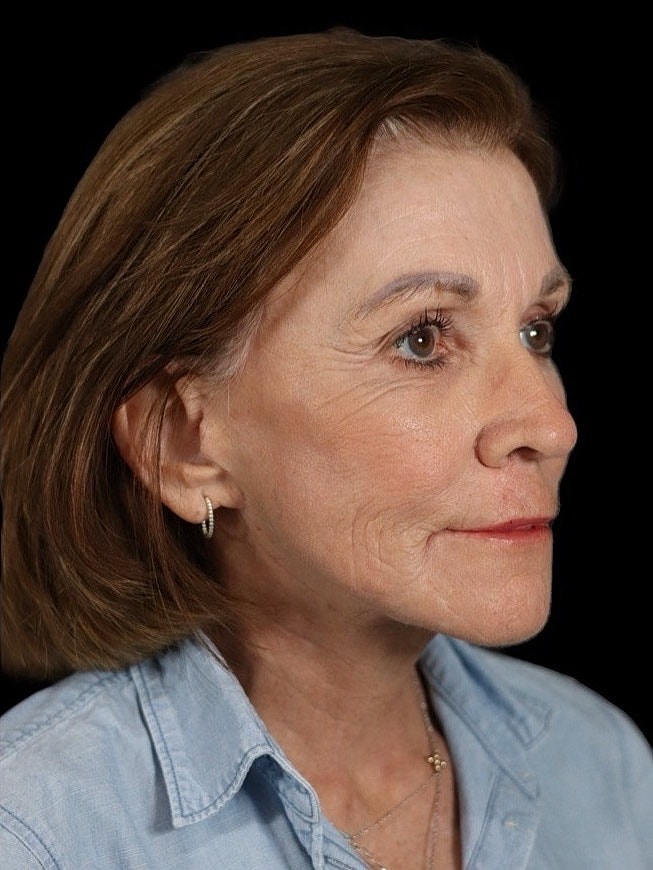 Deep Plane Facelift Gallery Before & After