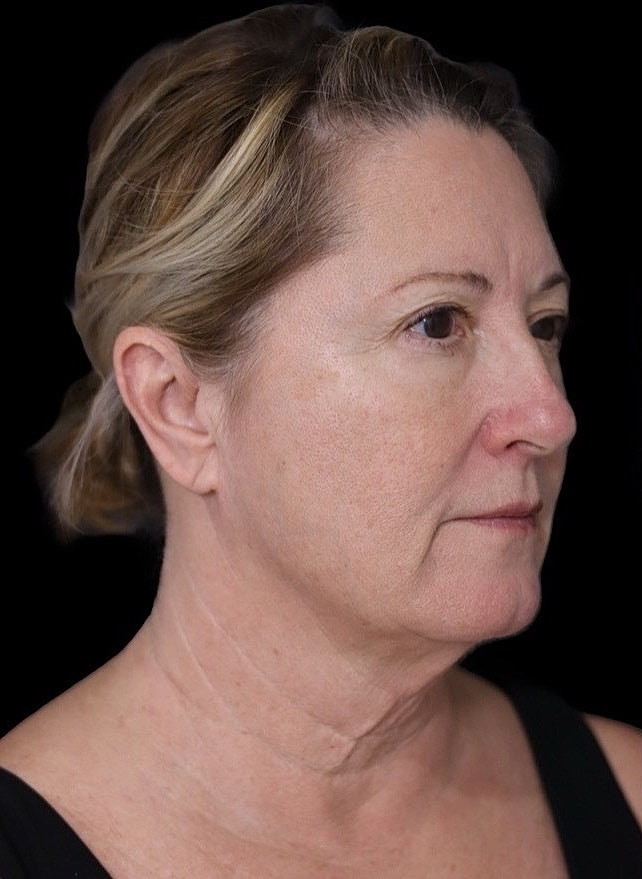 Deep Plane Facelift Gallery Before & After