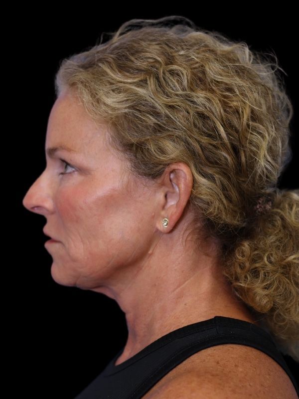 Deep Plane Facelift Gallery Before & After